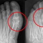 gout-xray-200-300